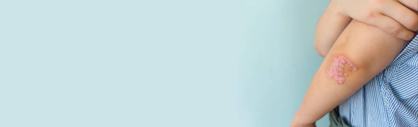 Psoriasis Treatment in Delhi