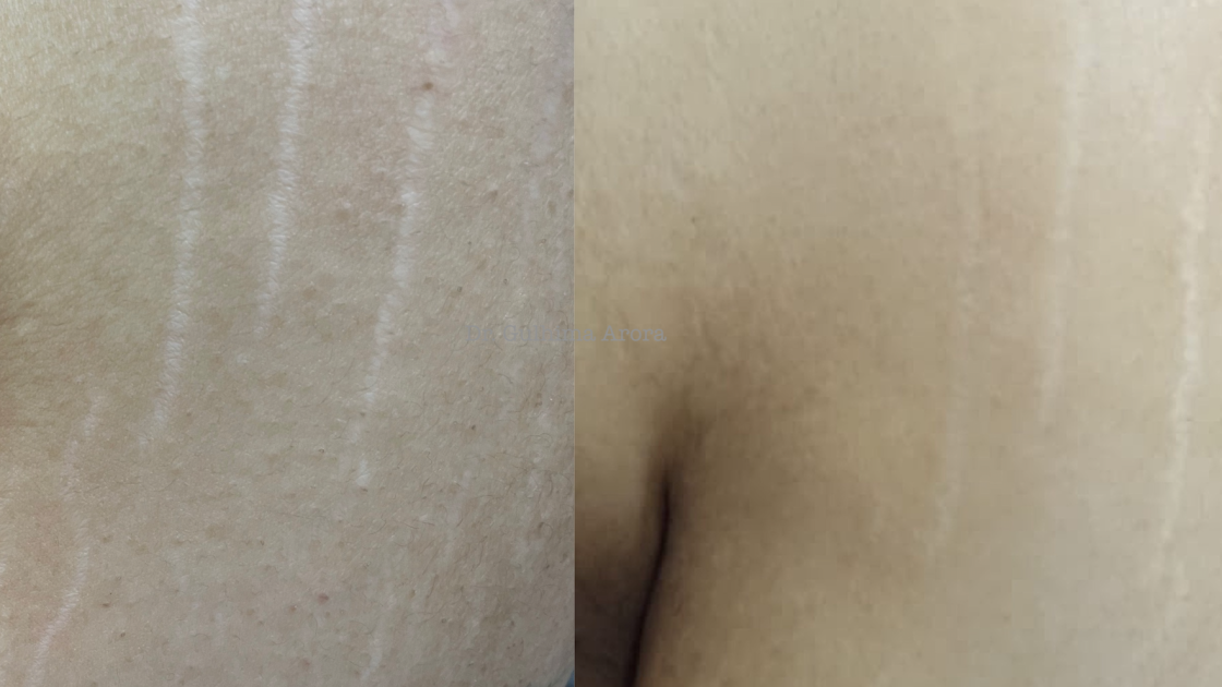 Get Rid of Acne Scars: Prevention and Treatment Options for Healthy Skin