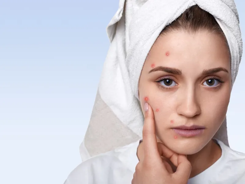 Get Rid of Acne Scars: Prevention and Treatment Options for Healthy Skin