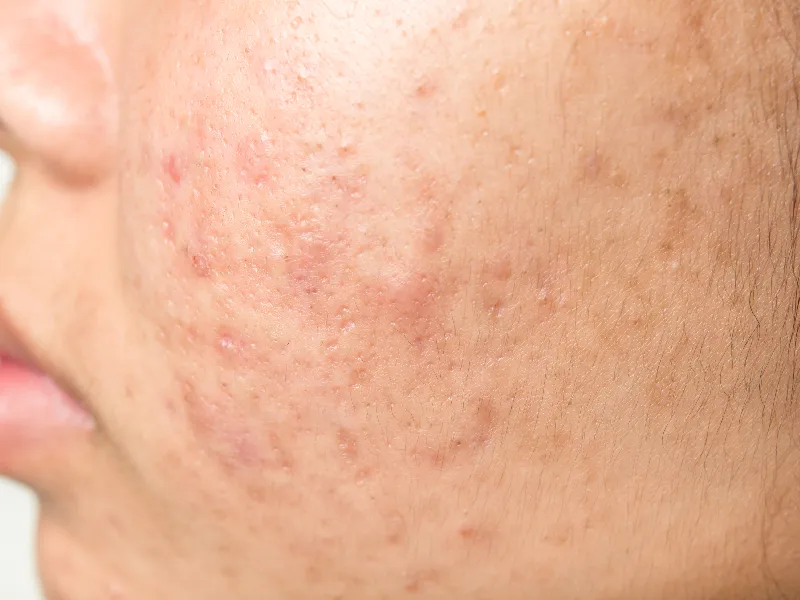 Get Rid of Acne Scars: Prevention and Treatment Options for Healthy Skin