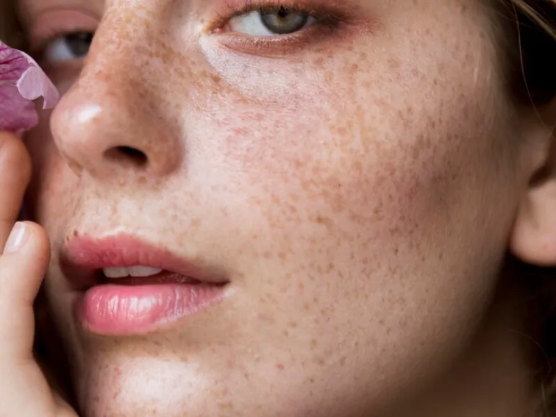 Pigmentation Problems: Types, Prevention, and Effective Treatments
