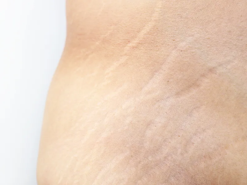 Tips to Get Rid of Stretch Marks on the Body Permanently