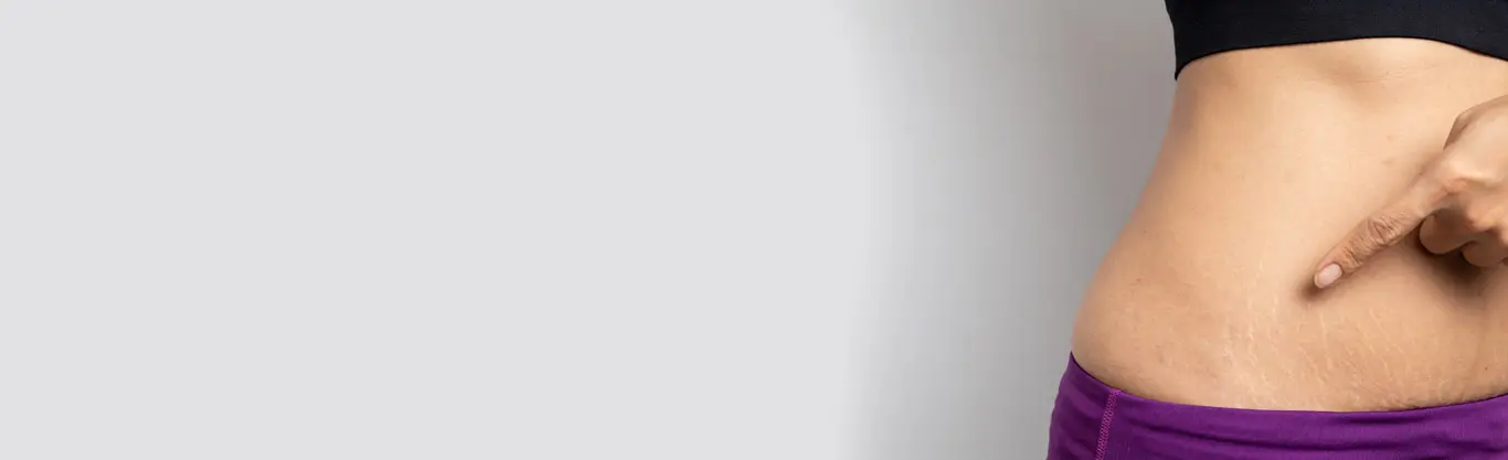 Stretch Marks Treatment in Delhi