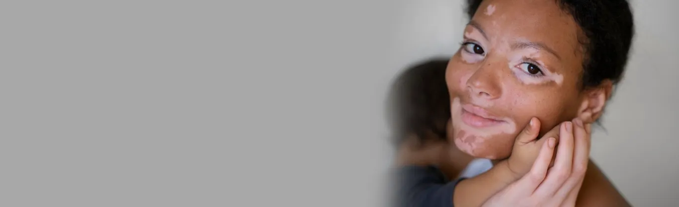 Vitiligo Treatment in Delhi