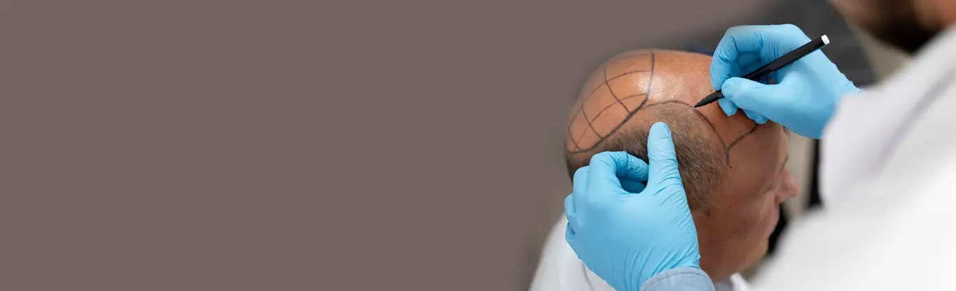 Hair Transplantation Procedures