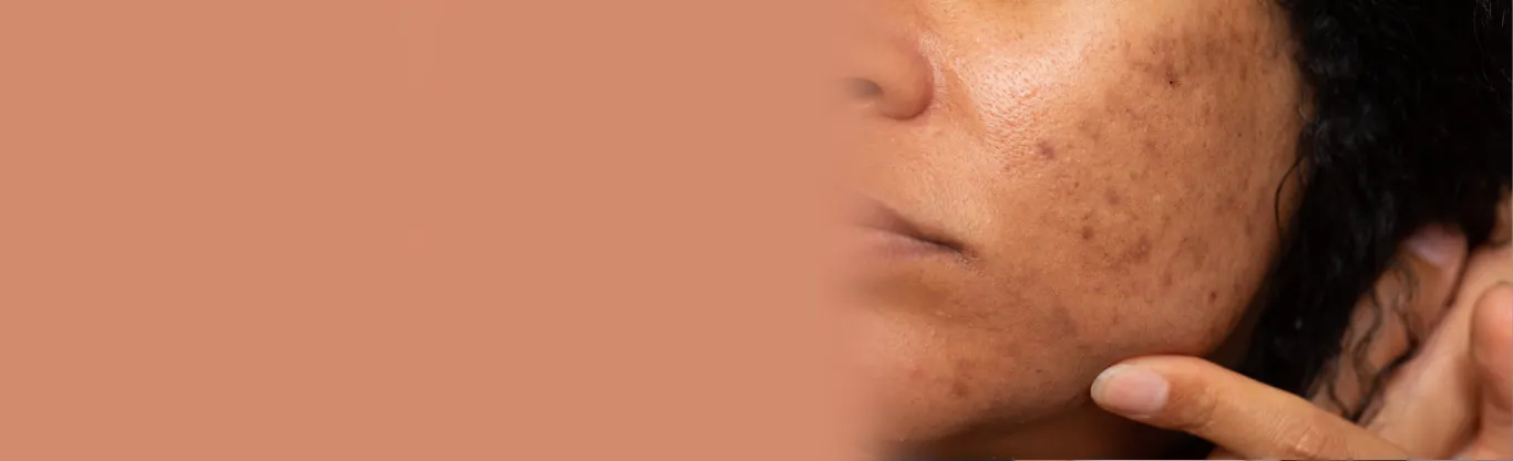 Acne Scar Treatment in Delhi