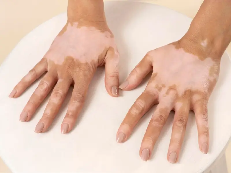 Understanding Types of Vitiligo and Its Common Symptoms