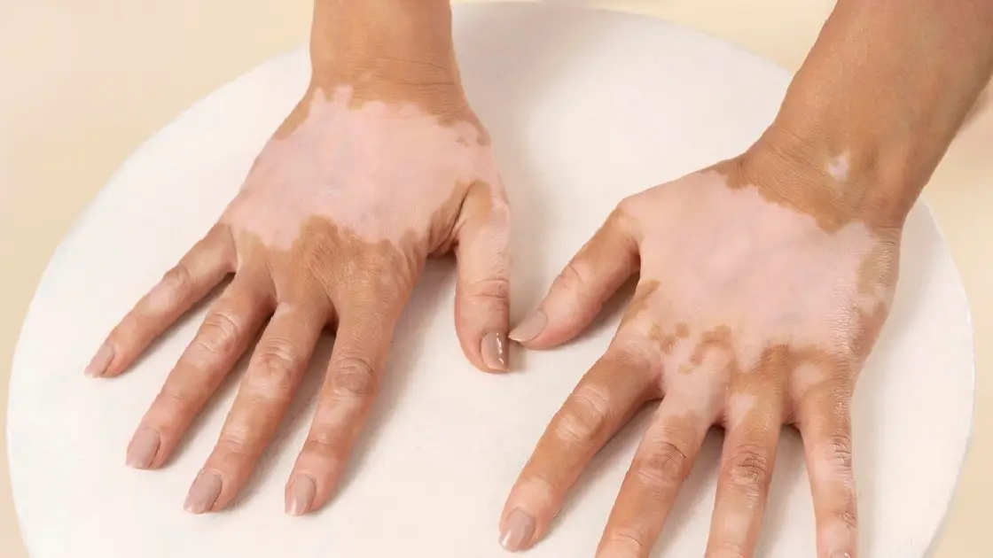 Understanding Types of Vitiligo and Its Common Symptoms