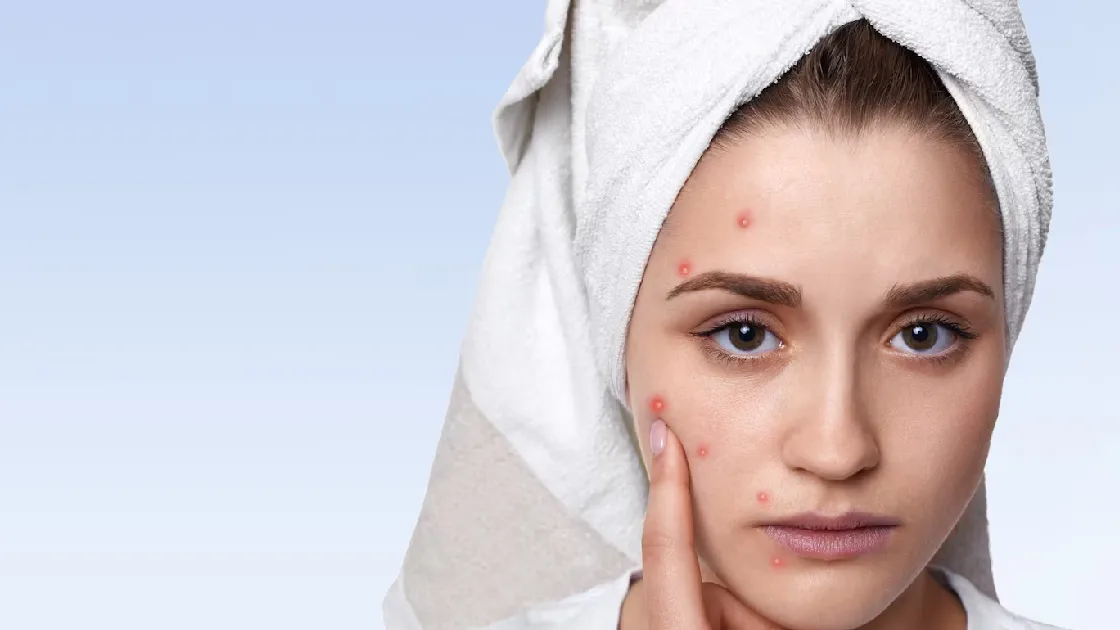 Dermatologist's Guide to Treating Different Types of Acne