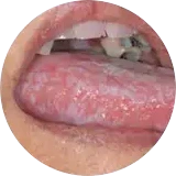 Mucosal Vitiligo