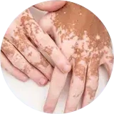 Localised Vitiligo