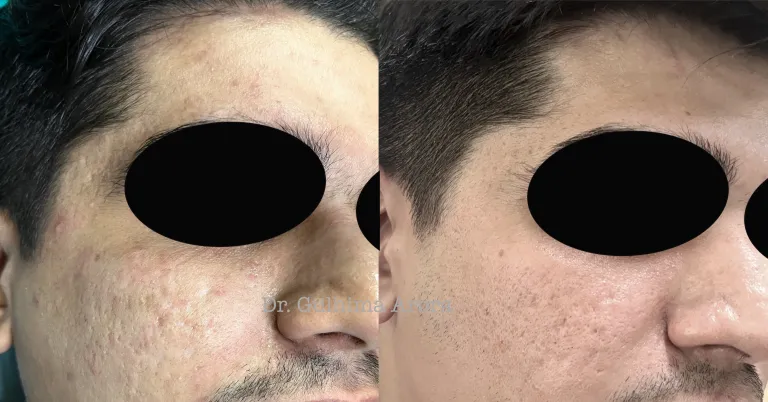 Before and after acne treatment on male patient