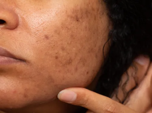 Acne Scar Treatment in Delhi