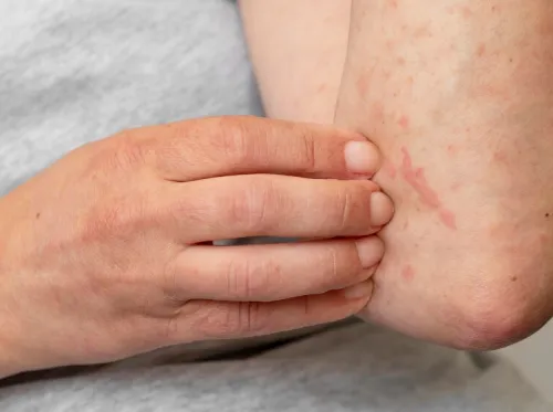 Eczema Treatment