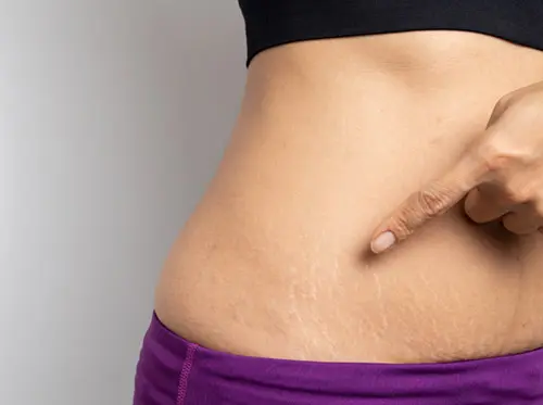 Stretch Marks Treatment in Delhi