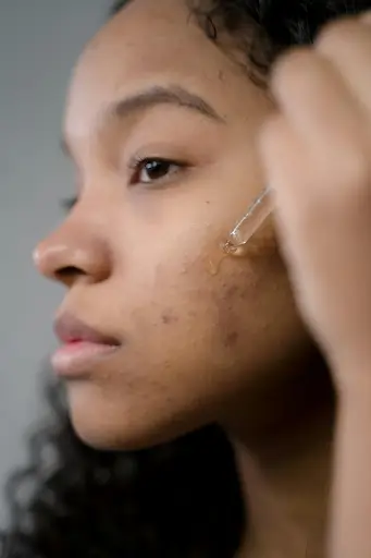 woman applying serum to acne-prone skin